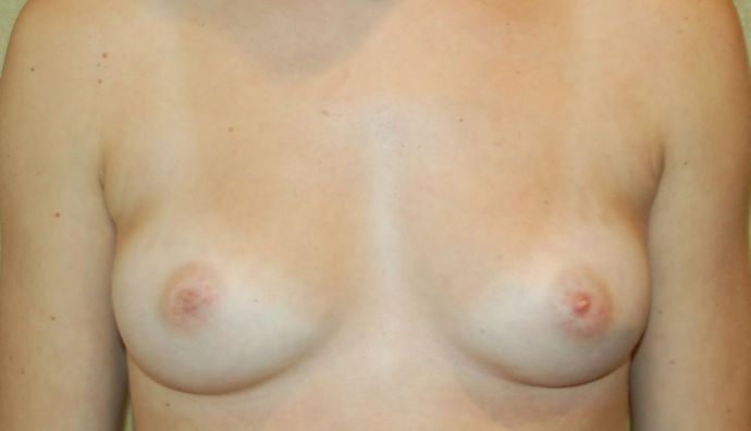 Breast Augmentation Case 529 - Before