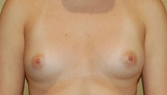 Breast Augmentation Case 530 - Before
