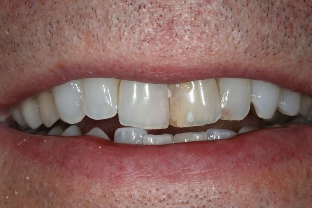 Implant Retained Crowns: Ted - Before