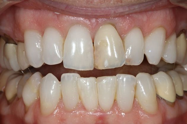 Implant Retained Crowns: Ted - Before