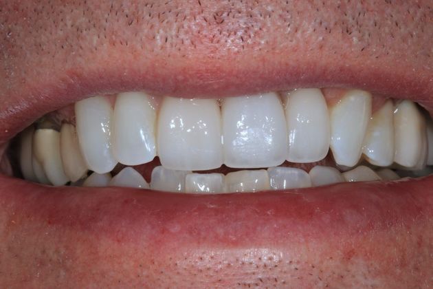 Implant Retained Crowns: Ted - After