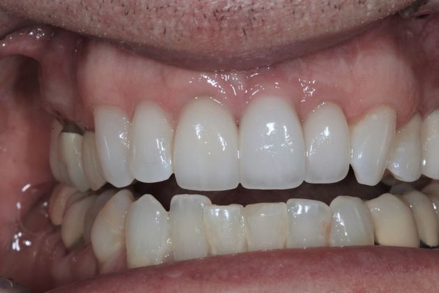 Implant Retained Crowns: Ted - After