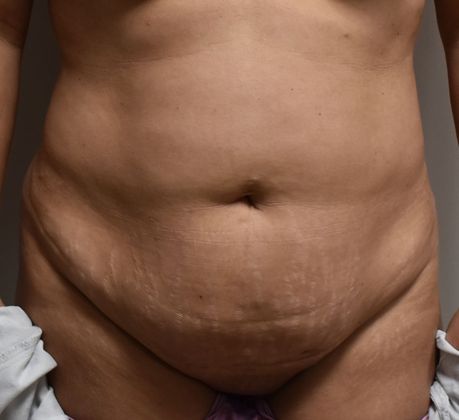 Tummy Tuck (Abdominoplasty) Case 170 - Before