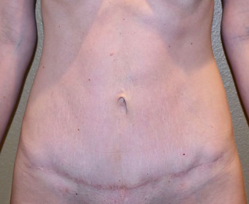 Tummy Tuck (Abdominoplasty) Case 171 - After