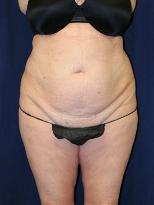 Liposuction & Safe Lipo Case 32 - Before