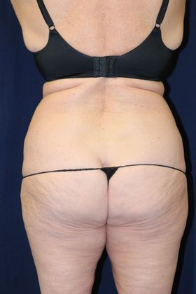 Liposuction & Safe Lipo: Case 32 - Before