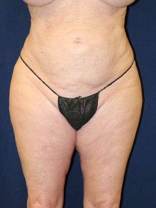 Liposuction & Safe Lipo Case 32 - After