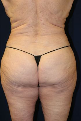Liposuction & Safe Lipo: Case 32 - After