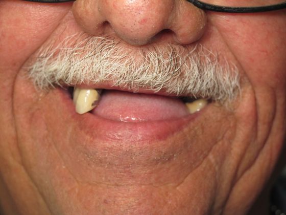 Teeth in a Day: Victor - Before