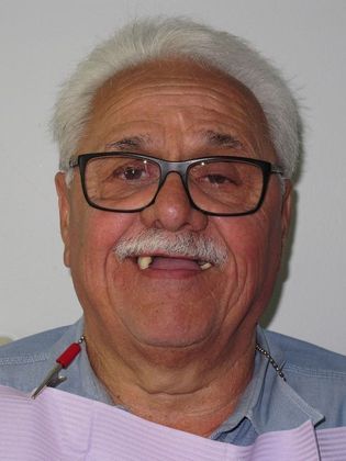 Teeth in a Day Victor - Before