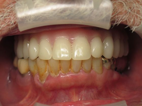 Teeth in a Day: Victor - After