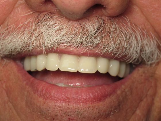 Teeth in a Day: Victor - After