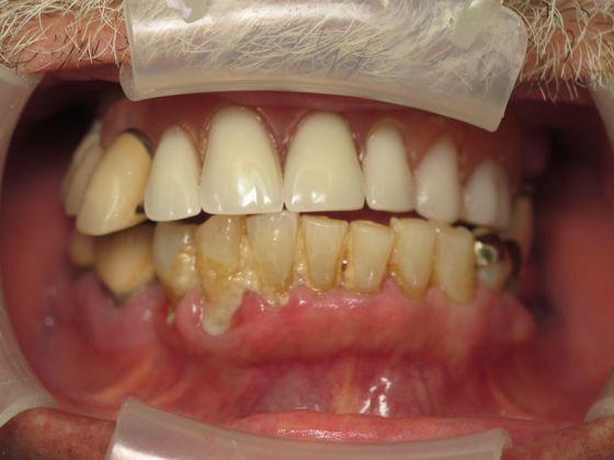 Teeth in a Day: Victor - Before