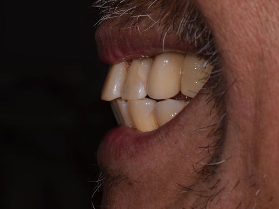 Individual Implants: Case 6 - After