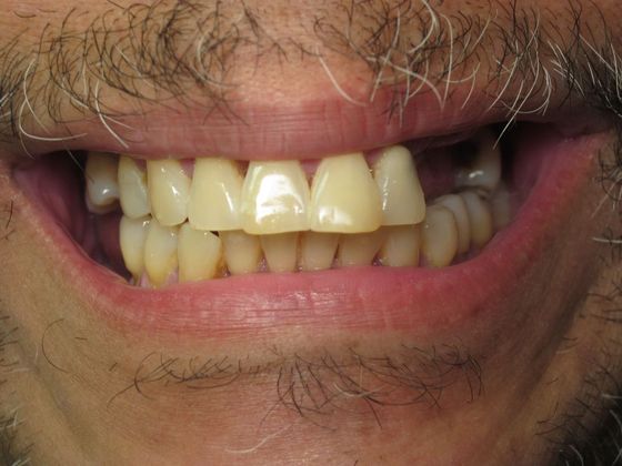 Individual Implants: Case 6 - Before