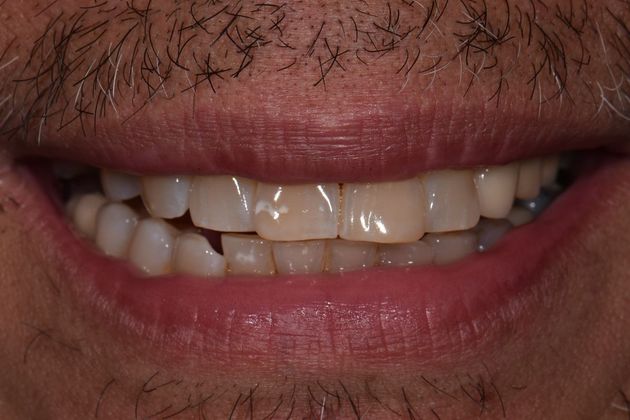 Individual Implants: Case 6 - After