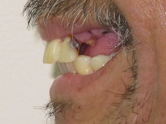 Individual Implants: Case 6 - Before