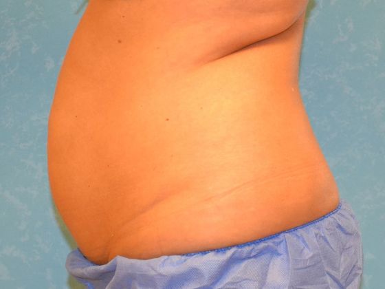 Coolsculpt: Case 1322- Erie, MI - Before