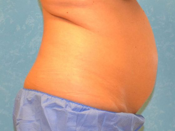 Coolsculpt: Case 1322- Erie, MI - Before