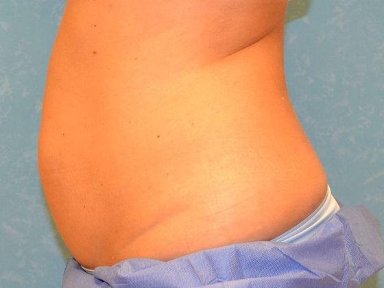 Coolsculpt: Case 1322- Erie, MI - After