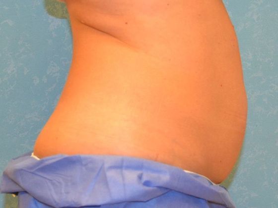 Coolsculpt: Case 1322- Erie, MI - After