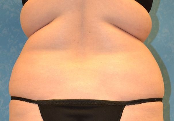 Liposuction: Case 1526- Milan, MI - Before