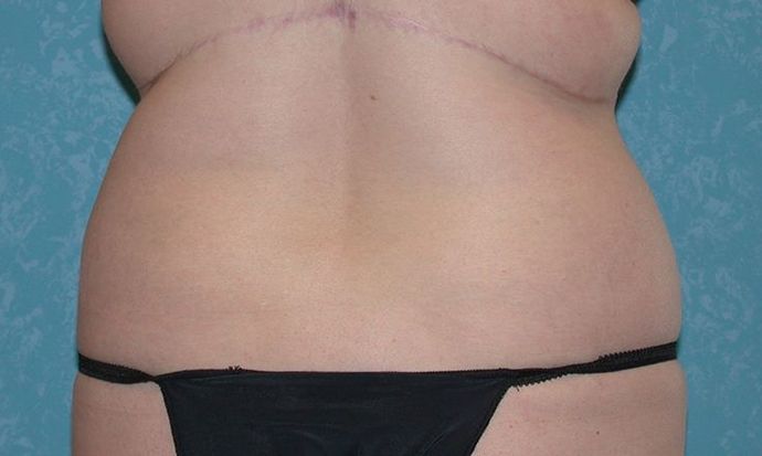 Liposuction: Case 1526- Milan, MI - After