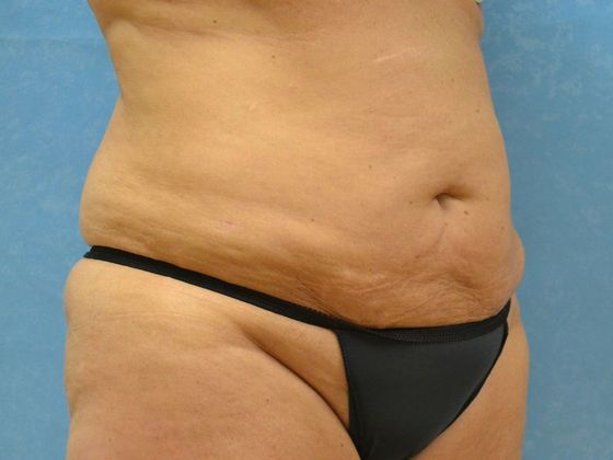 Liposuction: Case 1527- Toledo, OH - After