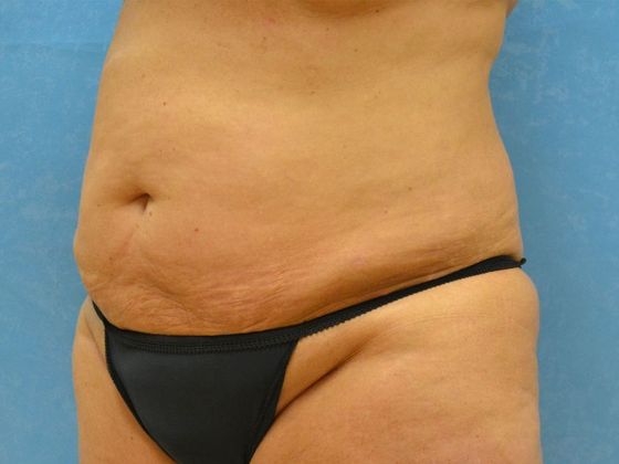 Liposuction: Case 1527- Toledo, OH - After