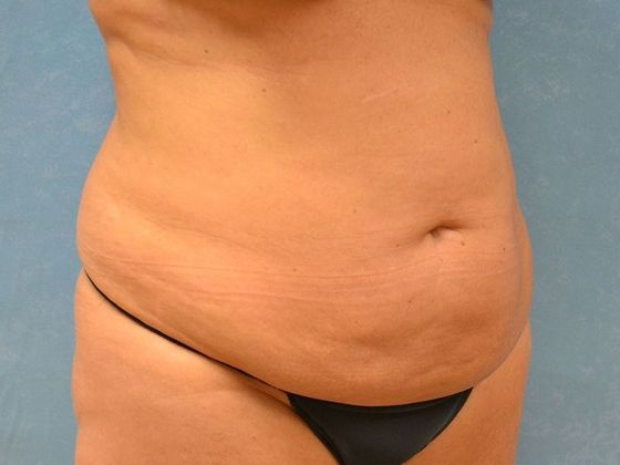Liposuction: Case 1527- Toledo, OH - Before