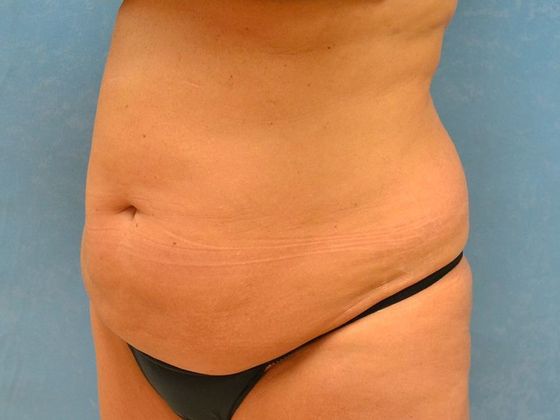 Liposuction: Case 1527- Toledo, OH - Before