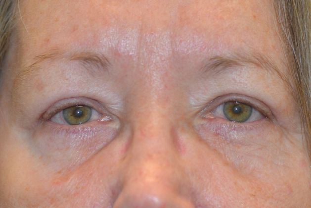 Upper Eyelid Blepharoplasty: Case 61 - After