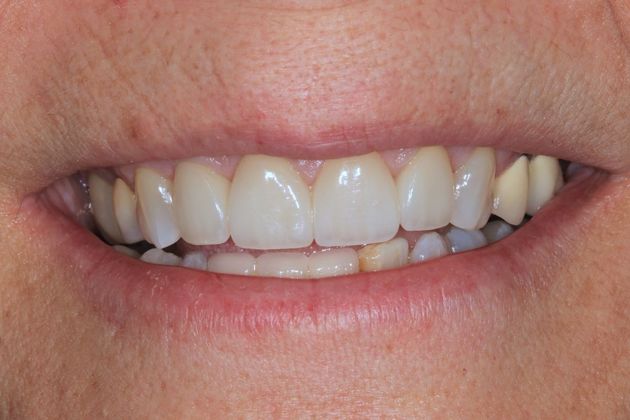 Porcelain crowns: Nancy