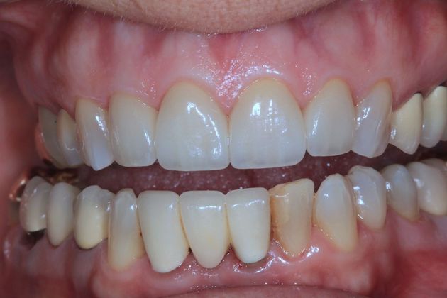 Porcelain crowns: Nancy