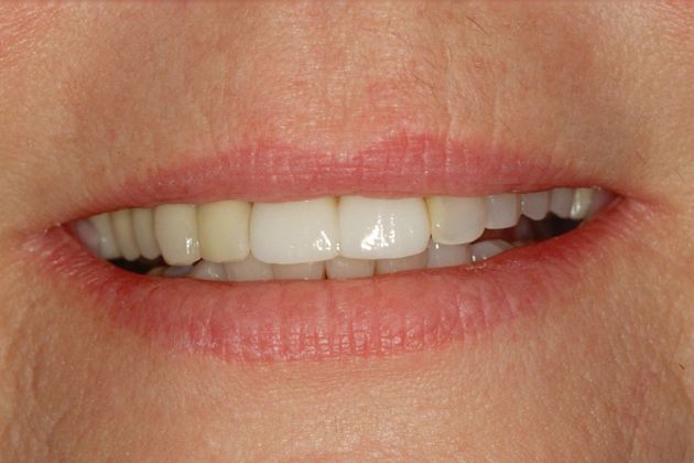 Full Mouth Rehabilitation Donna - Before