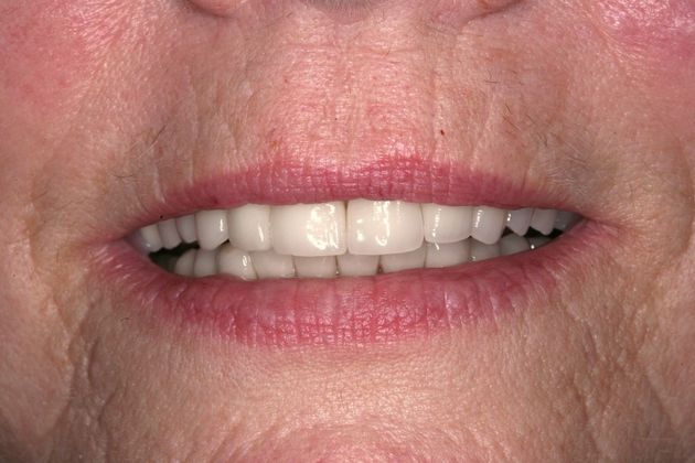 Full Mouth Rehabilitation Donna - After