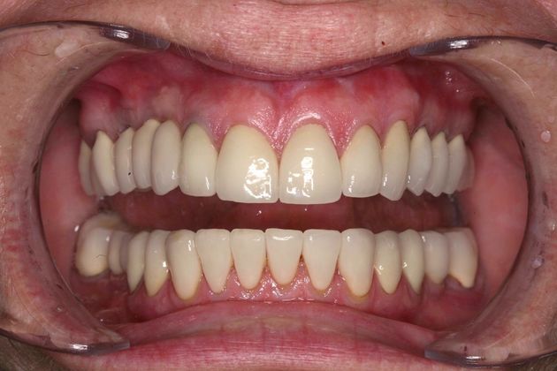 Full Mouth Rehabilitation: Donna - After