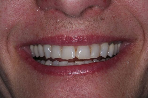 Full Mouth Rehabilitation: Marianne - Before