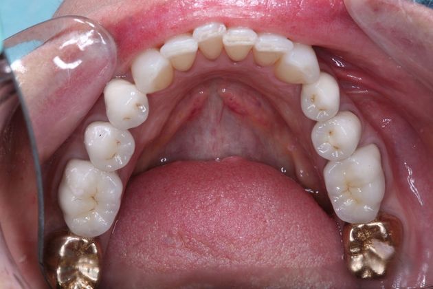 Full Mouth Rehabilitation: Marianne - After