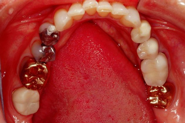 Full Mouth Rehabilitation: Marianne - Before