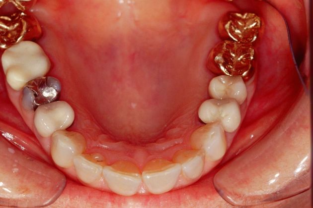 Full Mouth Rehabilitation: Marianne - Before