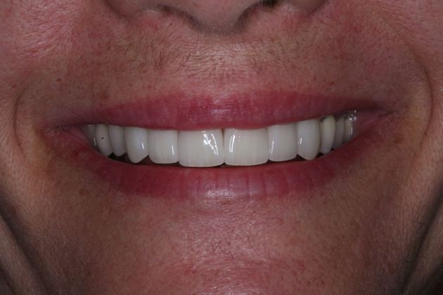 Full Mouth Rehabilitation: Marianne - After