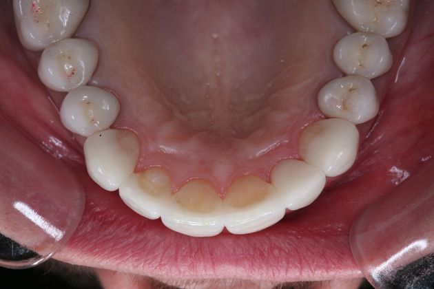 Full Mouth Rehabilitation: Marianne - After