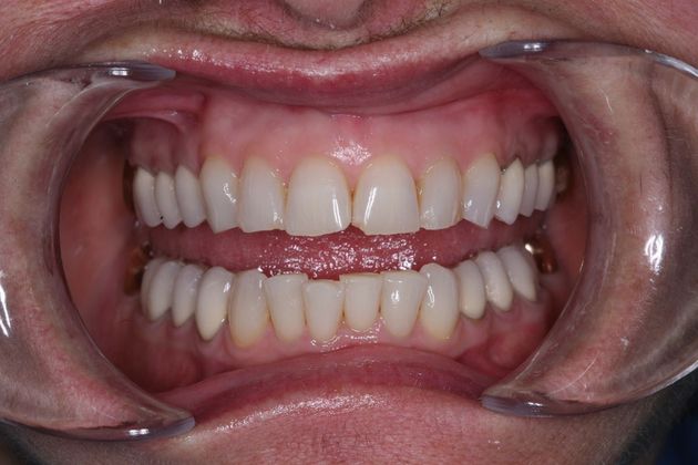 Full Mouth Rehabilitation: Marianne - Before