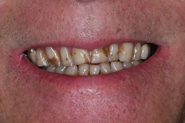 Full Mouth Rehabilitation: Richard - Before