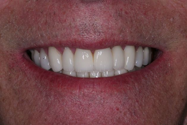 Full Mouth Rehabilitation: Richard - After