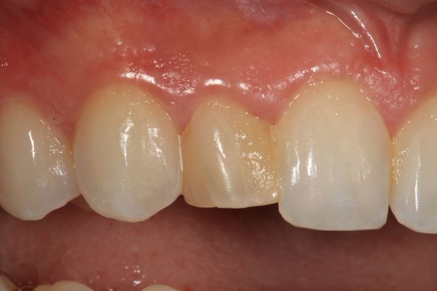 Dental Bonding: Bianca - Before