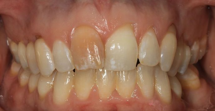 Porcelain crowns: Kim - Before