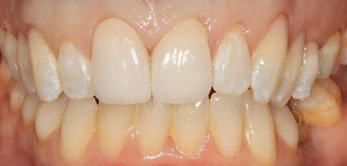 Porcelain crowns: Kim - After