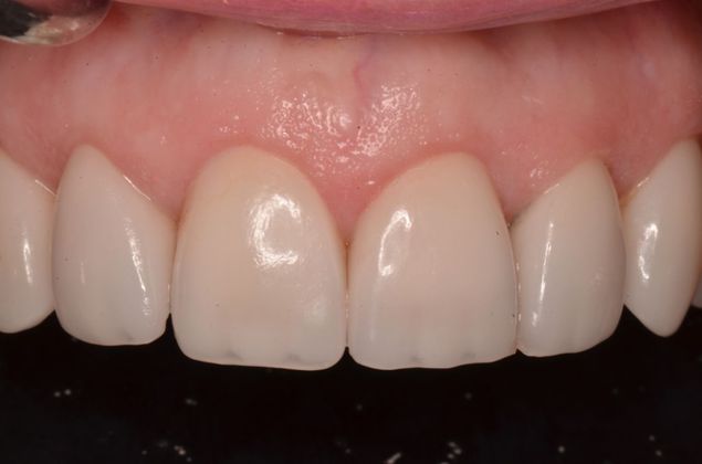 Porcelain Veneers: Case 15 - After